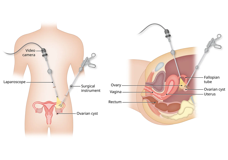 Dr. Harshrika Holkar is recognized as the best doctor for Ovarian Cystectomy Treatment in Thane, Mumbai, providing expert care and tailored solutions.